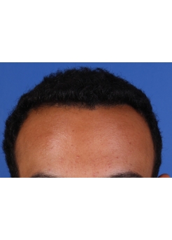 After Hair Transplant&nbsp;Front